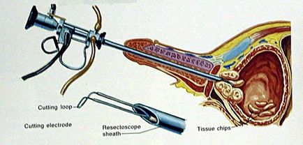 Hiperplazia prostatică benignă sau adenomul prostatic