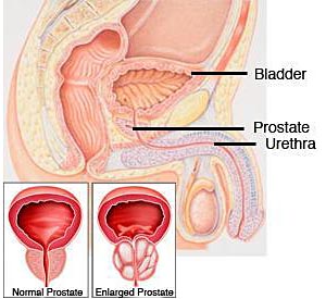 Hiperplazia prostatică benignă sau adenomul prostatic