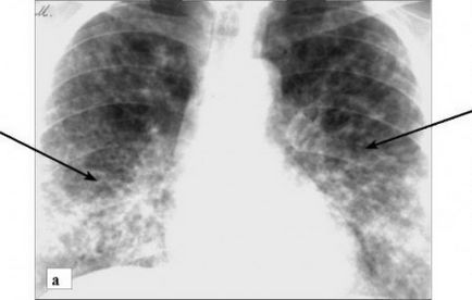 Pneumonia cu două fețe inferior prezintă diagnostice și tratament