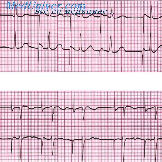 Ex cardiologie - tratament cardiac