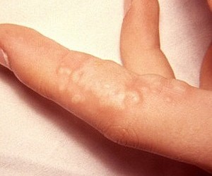 Герпес на пальцях рук фото симптоми