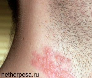 Herpes zoster és a nemzeti kezelési (herpes zoster) Herpes zoster gyógyszeres kezelés és a nemzeti