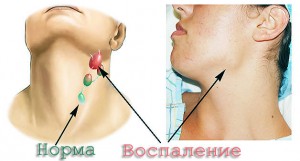 Гігрома на шиї симптоми, діагностика та лікування