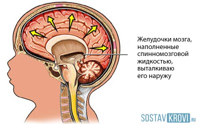 Sindromul hipertensiv la copii, nou-născuți, adulți, cauze, simptome, tratament