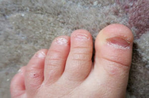 Грибок нігтів у дітей причини, симптоми і лікування грибка