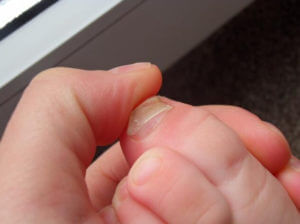 Грибок нігтів у дітей причини, симптоми і лікування грибка