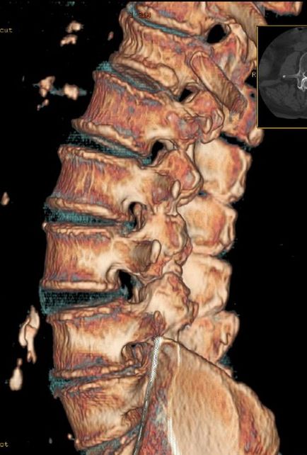 Hernia pe radiografia coloanei vertebrale poate fi văzută și descrisă