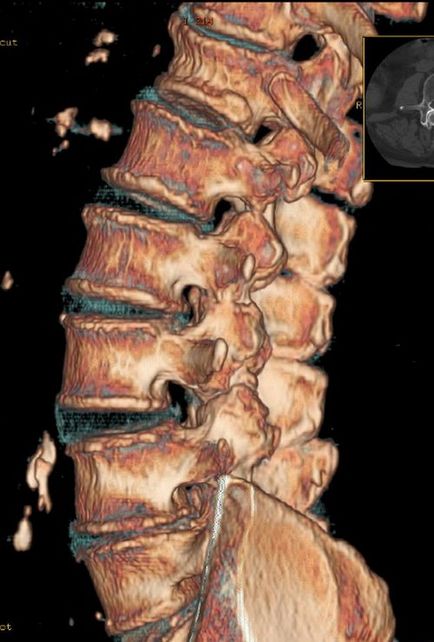 Грижа на рентгені хребта чи можна побачити і як описується