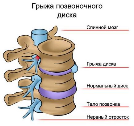 Hernia pe radiografia coloanei vertebrale poate fi văzută și descrisă