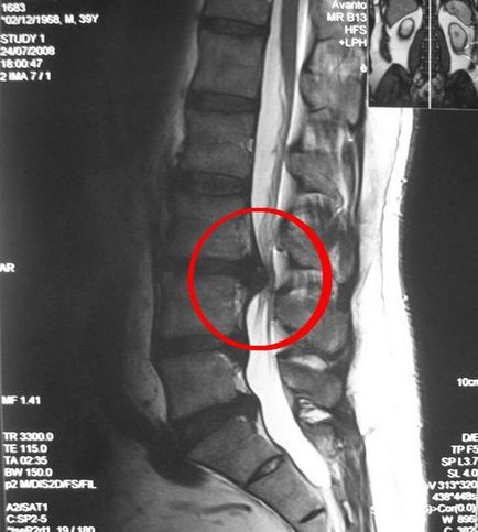 Hernia pe radiografia coloanei vertebrale poate fi văzută și descrisă