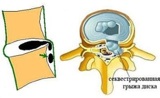 Herniated lumbar coloanei vertebrale simptome, tratament, cauze