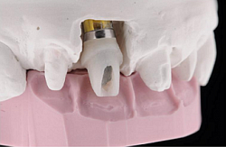 Hi-tec implants