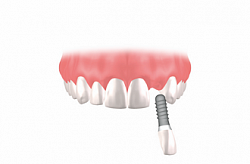 Hi-tec implantátumok