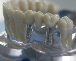 Implantarea dinților, stomatologia - președinția - într-o întâmpinare
