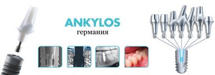 Імпланти ankylos особливості, моделі каталогу, абатменти, установка і термін служби