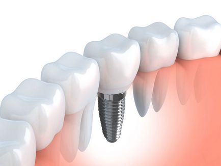 Az implantátumok hi-tec - egy jó fogorvos St. Petersburg - Viborg kerületben metró tavak