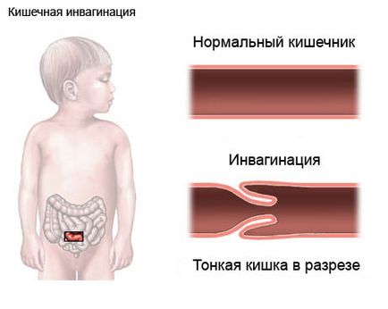 Інвагінація кишечника у дітей симптоми і лікування
