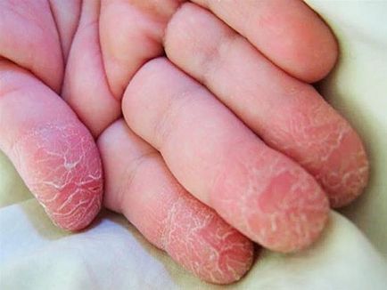 Cum să preveniți avitaminoza de primăvară la copiii cu fotografii ale simptomelor pe pielea mâinilor