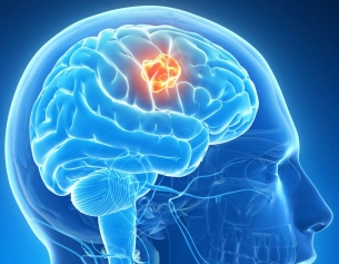 Hogyan ismerjük fel a stroke (érkezés a mentőket) Hogyan ismerjük fel a stroke