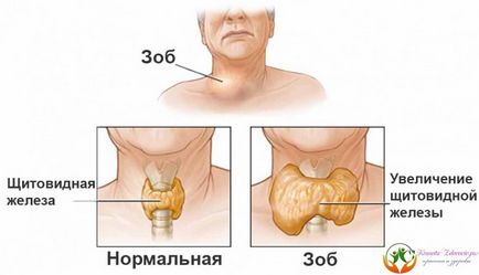 Як вилікувати зоб щитовидної залози в домашніх умовах