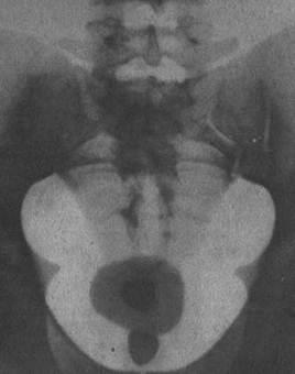 Húgykő - klinikai (tünetek), diagnosztika, kezelés, megelőzés és prognózis