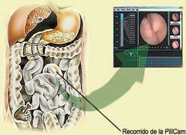 Endoscopie capsulară (tabletă electronică) - Portalul Medical Siberian