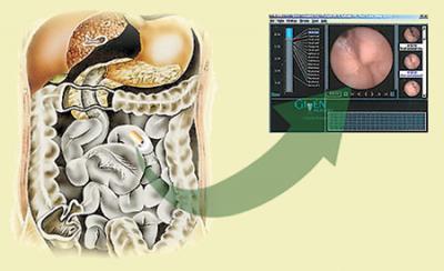 Endoscopia capsulară a intestinului subțire, o nouă metodă de examinare