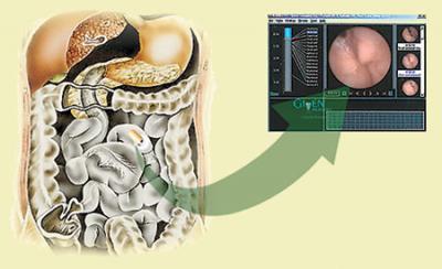 A kapszula endoszkópia, a vékonybél, egy új vizsgálati módszer