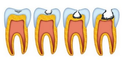 Dental caries, ce este?