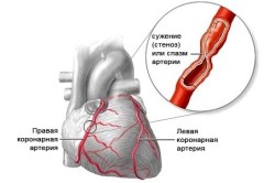 Clasificarea hipertensiunii arteriale