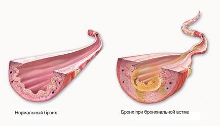 Класифікація бронхіальної астми види, форми, тяжкість