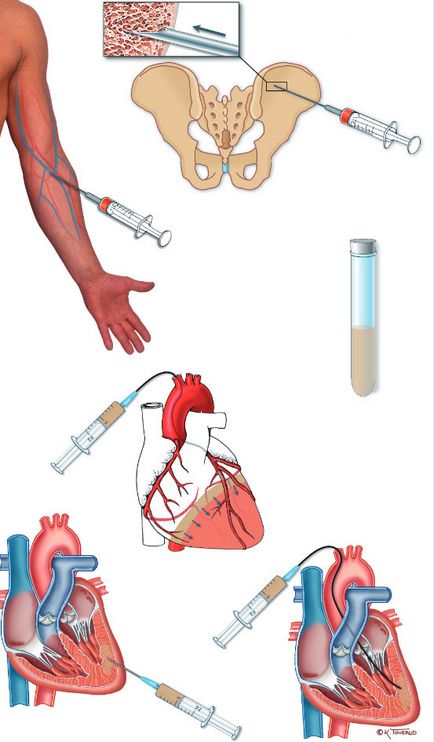 Terapia celulară a infarctului miocardic deja în Rusia