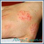 10 mb kód allergiás bőrgyulladás