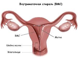 Коли можна ставити спіраль після пологів скільки часу потрібно почекати