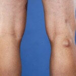 Коксартроз колінного суглоба або тазостегнового, розвіюємо міфи