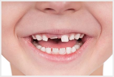 Коронки дітям на молочні зуби, дитяче зубне протезування в Краснодарі