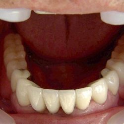 Koronák fogászatban alkalmazott - szike - orvosi információk és oktatási portál