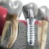Коронки, що застосовуються в стоматології - скальпель - медичний інформаційно-освітній портал