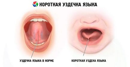 Коротка вуздечка мови у новонародженої дитини і дорослого, компетентно про здоров'я на ilive