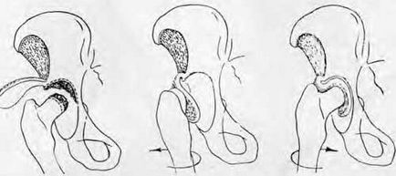 Diastasis csont - kezelés - a tuberkulózis, a csípőízület (koksz) - Klinika és kezelése