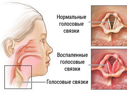 Ларингіт - лікування хвороби