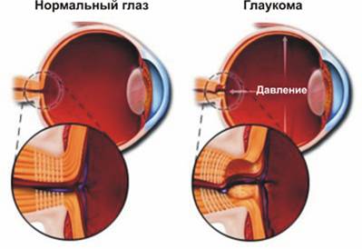 Лазерне лікування глаукоми в москві, вартість лікування глаукоми лазером
