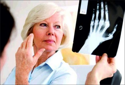 Tratamentul artritei cu remedii populare