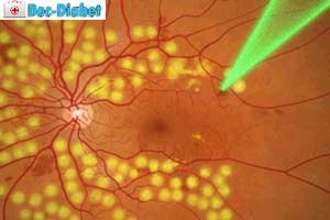 Tratamentul retinopatiei diabetice a stadiilor oculare și a simptomelor