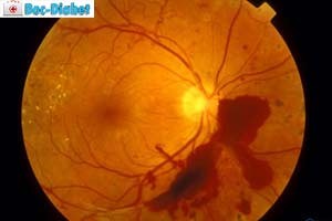 Diabéteszes retinopátia szem - szakaszában, és a tünetek