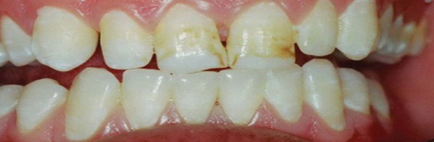 Лікування флюорозу в москві від 13 000 руб - стоматологічна клініка mextodent
