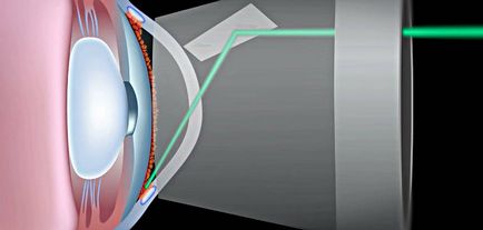 Tratamentul glaucomului cu laser - prețurile pentru o operație la Moscova, recenzii ale pacienților