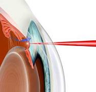 Tratamentul laser al glaucomului în Clinica Konovalov