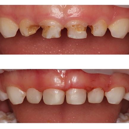 Tratamentul dinților sugarilor