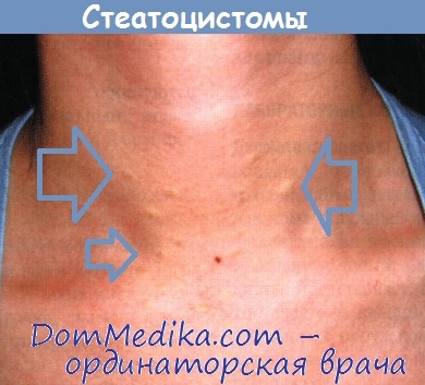 Steatochistomul multiplu - diagnostic, tratament